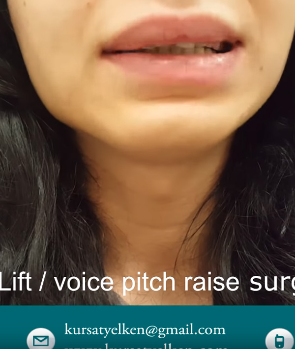 Voice Feminization Surgery, Voice Lift Surgery